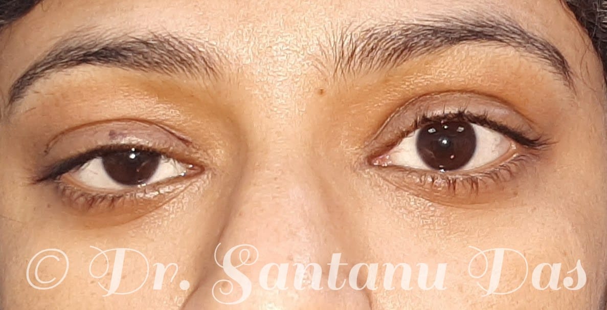 Ptosis Symptoms